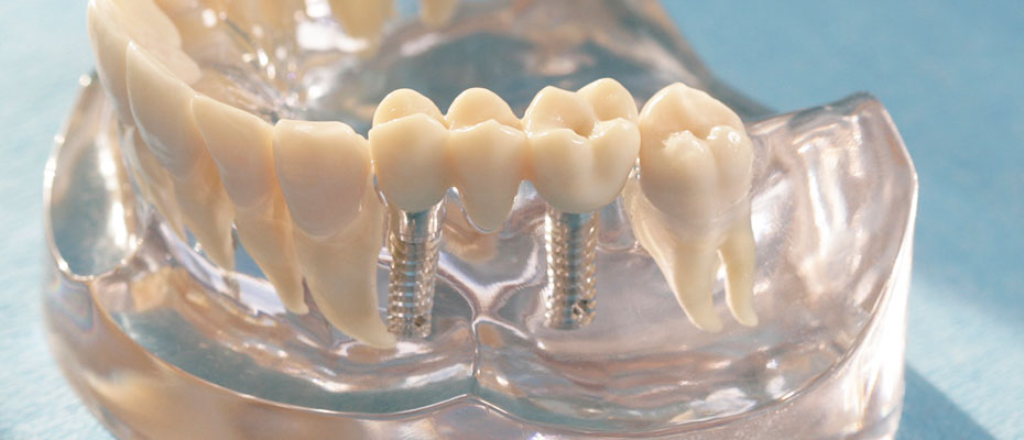 Zahnimplantate in Erding, schöne feste Zähne